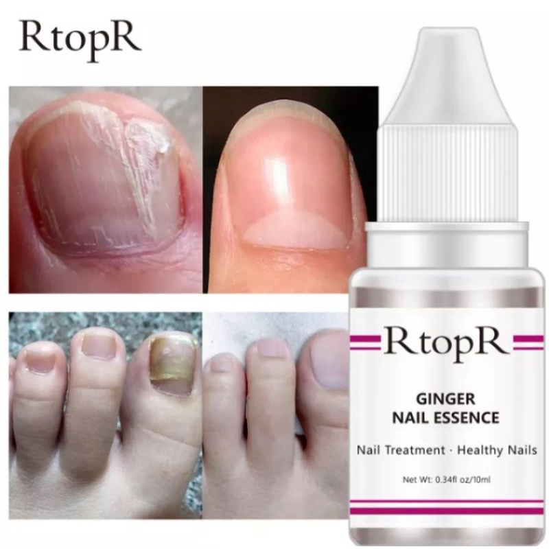 RtopR NAIL TREATMENT | PERAWATAN JAMUR KUKU |