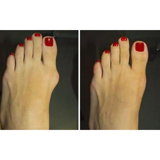 PELURUS JEMPOL KAKI, HALLUX VALGUS. SPLINT , BUNION PAD, NIGHT SPLINT