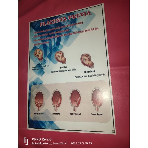 

Poster Plasenta Prifea