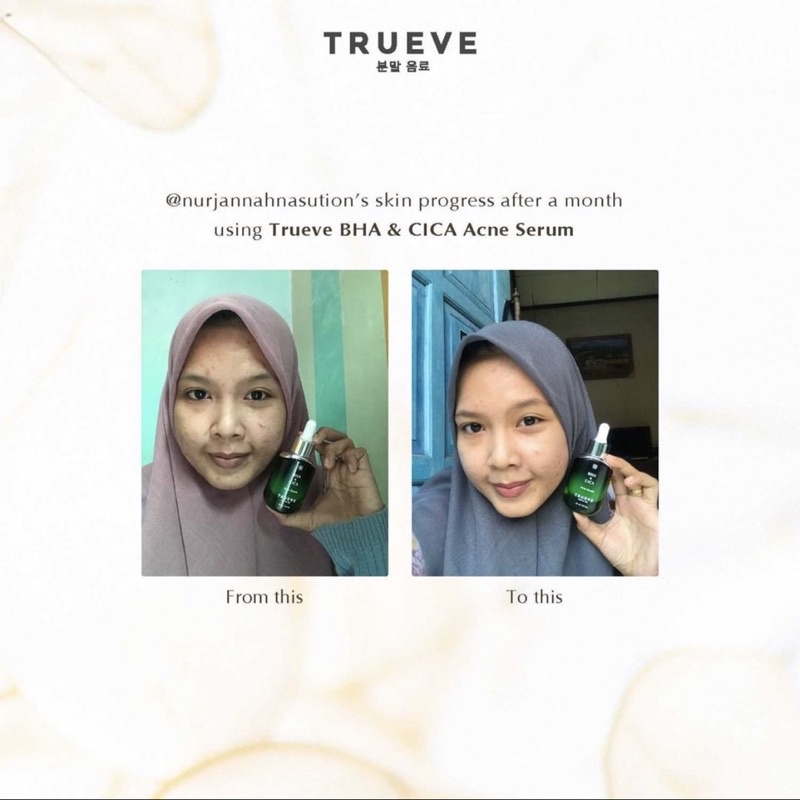 TRUEVE Acne Care Treatment Serum 30 ML (Serum Jerawat, Obat Jerawat, Serum Jerawat dan bekasnya)