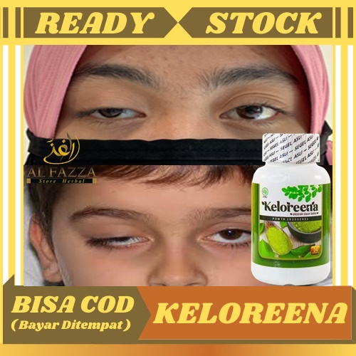 Obat Herbal Mata Ptosis, Kelopak Mata Turun Sebelah, Mata Lelah, Saraf Mata Lemah, Otot Mata Kendur