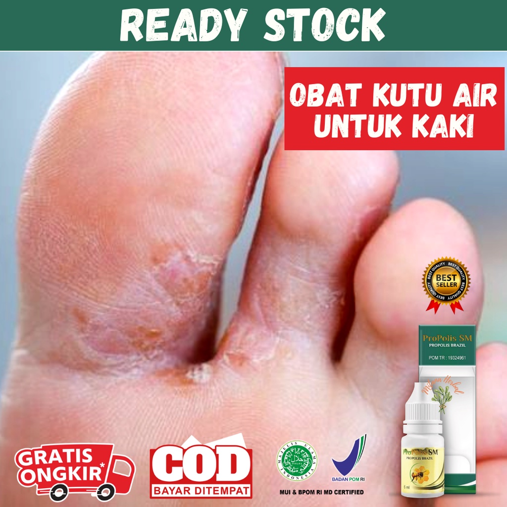 Obat Kutu Air Untuk Kaki, Obat Kutu Air Kaki, Obat Kutu Air Tangan, Salep Kutu Air - Propolis Sm