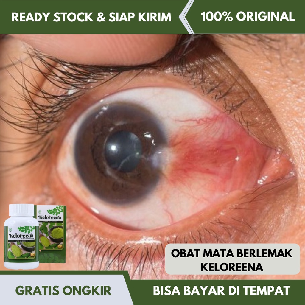 Obat Untuk Mata Berlemak, Pterigium, Pterygium, Mata Minus, Floaters Mata, Mata berkabut, Penghilang