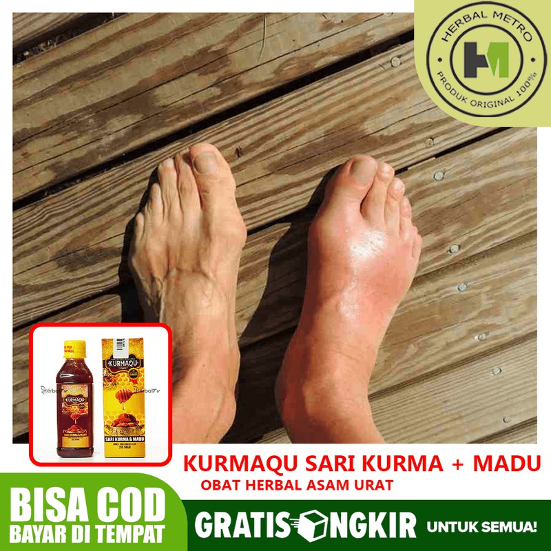 

Obat Asam Urat - Obat Tetes Untuk Asam Urat - Obat Herbal Asam Urat Sari Kurma Kurmaqu