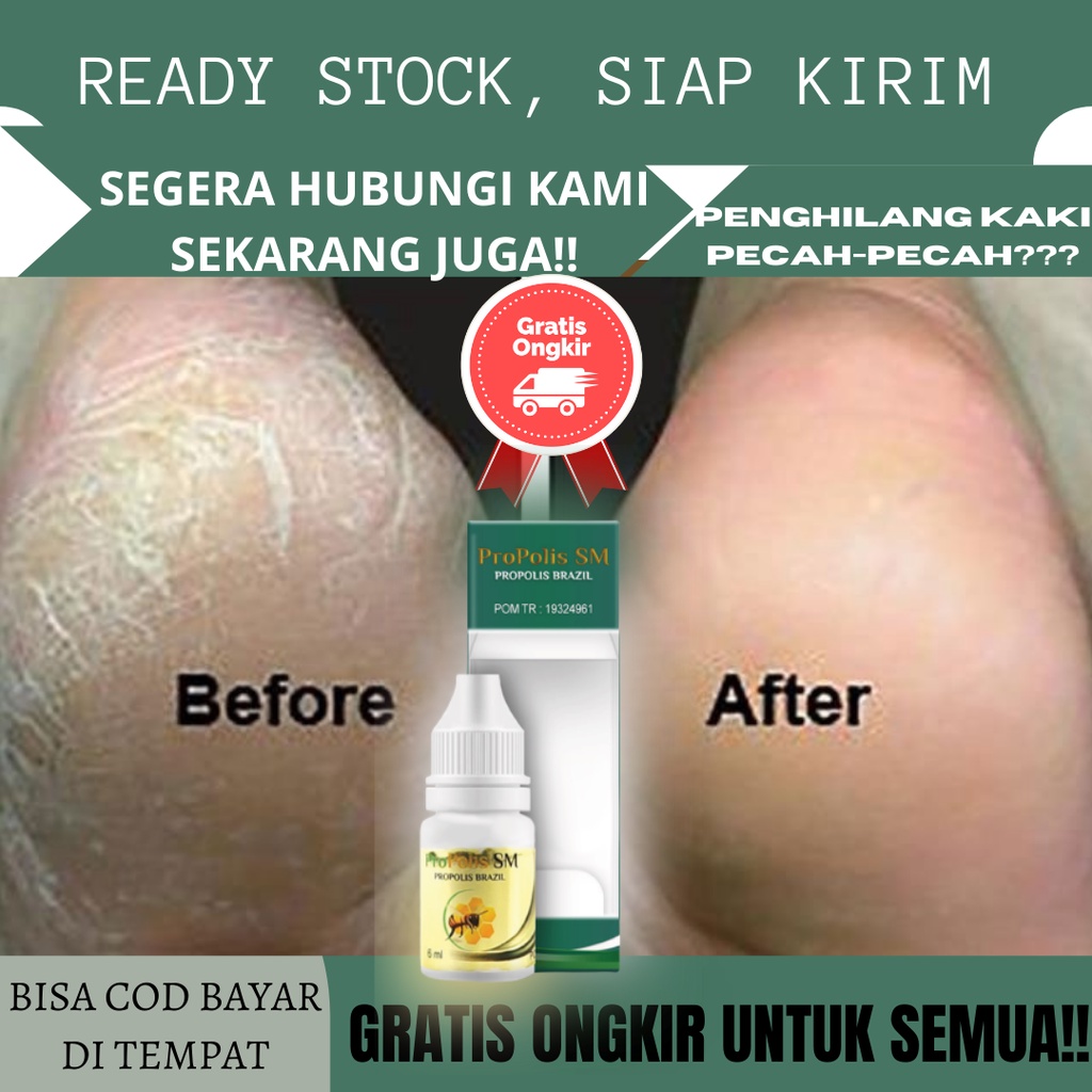 Obat kaki Pecah - pecah dan Kering, Obat Kaki Pecah Belah, Obat Kaki Kapalan, Obat Kaki Rayapan, Oba