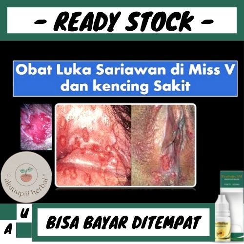 Obat Sariawan Di Miss V, Obat Penghilang Jamur Dimiss V, Obat Bercak Putih Dimiss V, Obat Oles Saria