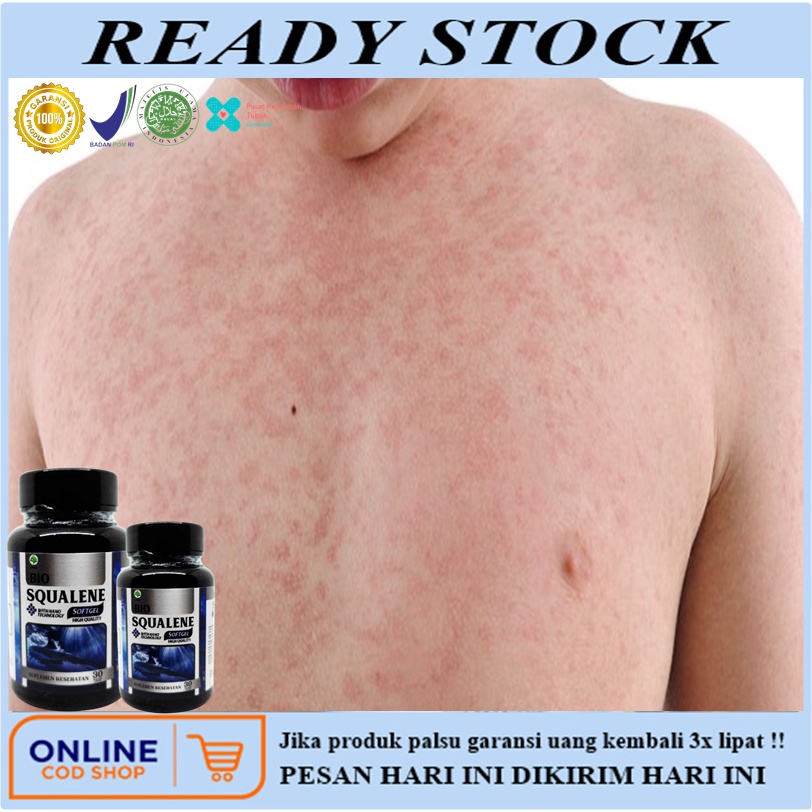 Obat gatal alergi, Obat alergi gatal kulit, Obat alergi, Salep gatal gatal, Obat biduran, Obat Obat 