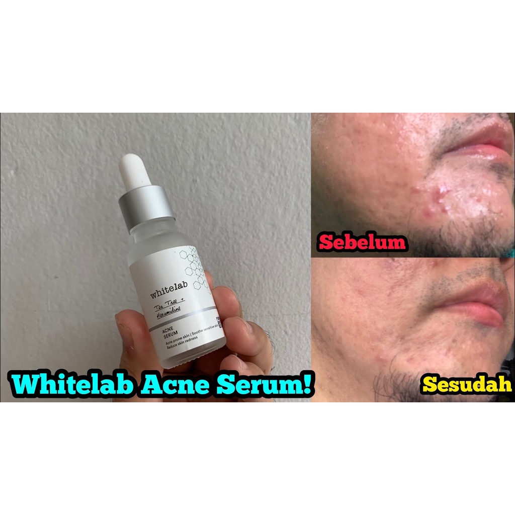 [COD] WHITELAB ACNE CALMING SERUM TEA TREE HEXAMIDINE &amp; CICA UNTUK WAJAH BERJERAWAT I 20ML ORI BPOM