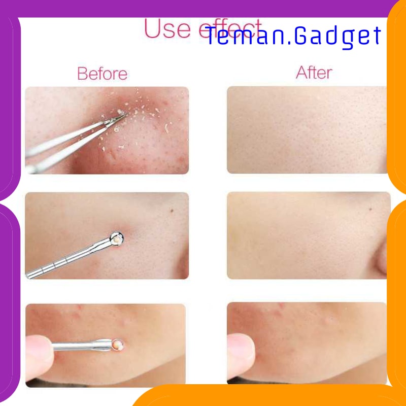 TG-FE219 BIUTTE.CO ALAT PERLENGKAPAN KOMEDO JERAWAT BLACKHEAD 3 PCS - PT3