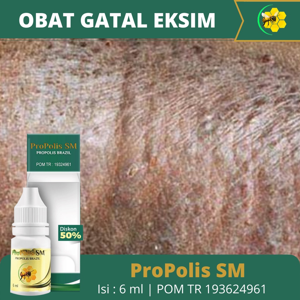 Obat Gatal Eksim Menahun, Obat Penghilang Gatel, Obat Gatal Eksim Basah Menahun, Obat Gatal, Obat Ga