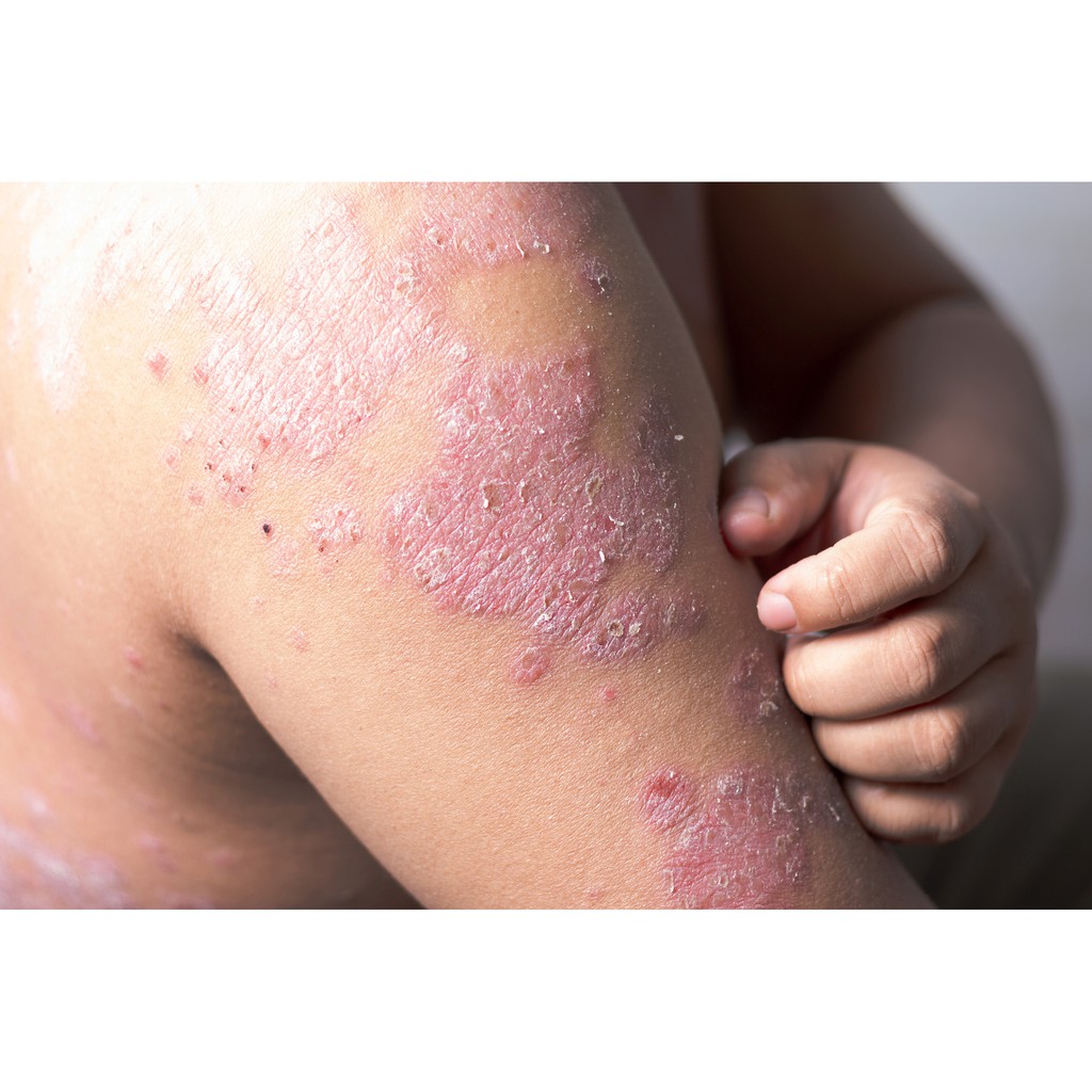 Salep Gatal Paling Ampuh Untuk Semua Penyakit Kulit Seperti Panu Kadas Kurap Kudis Kutu Air Shopee Indonesia