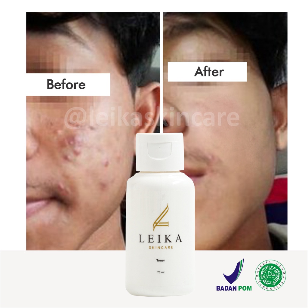 Toner Bagus Penghilang Jerawat Pria Toner Jerawat Ampuh Perawatan Wajah Pria Asli Resmi BPOM Pembers