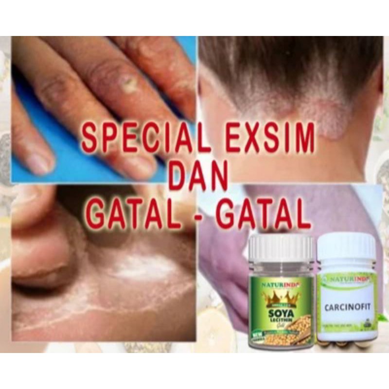OBAT GATAL EKSIM PENYAKIT KULIT GATAL GATAL SELANGKANGAN