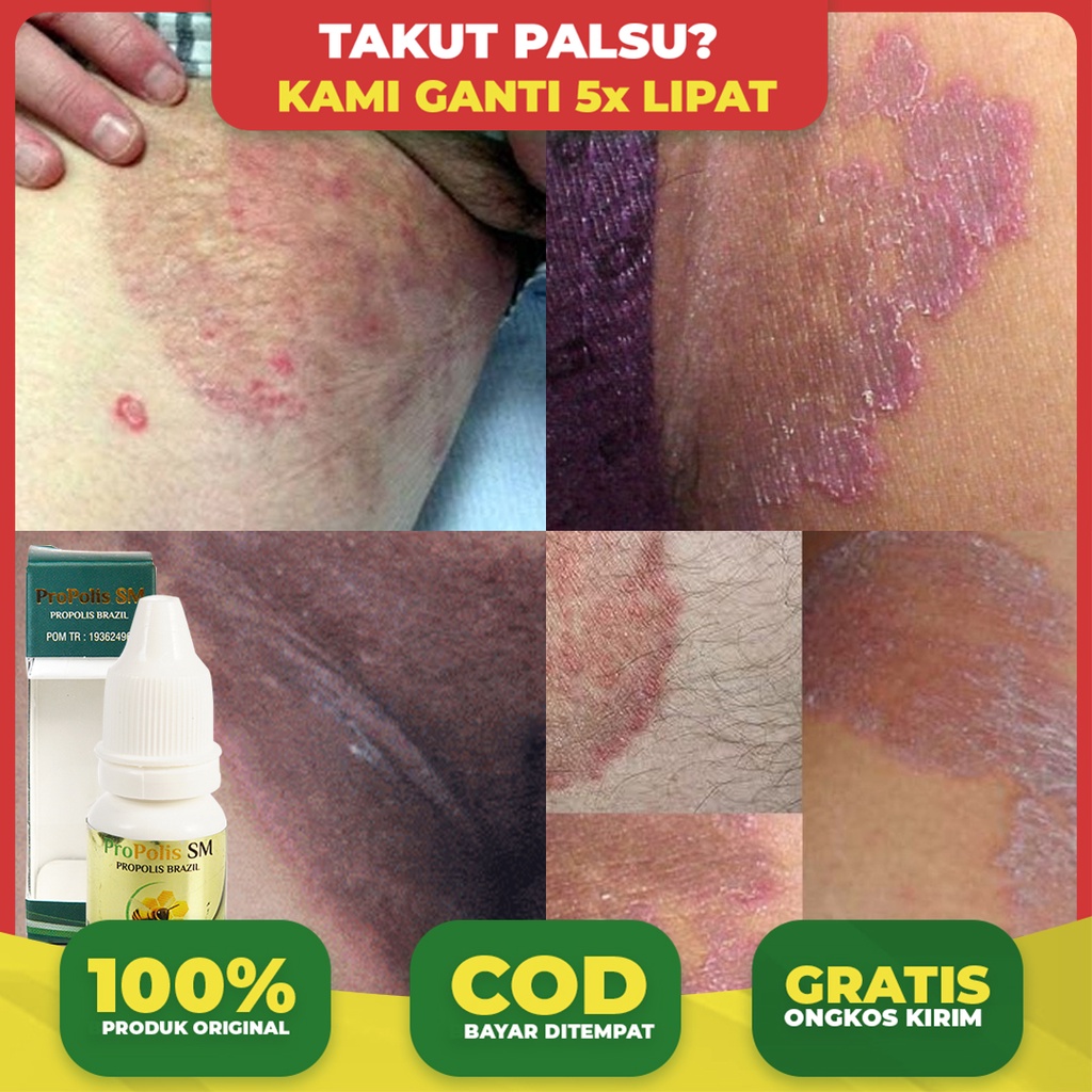Obat Gatal Selangkangan - Jamur Selangkangan - Penghilang Selangkangan Berwarna Hitam - Atasi Gatal 