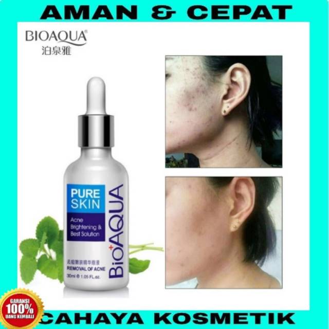 (ORIGINAL 100%) BIOAQUA PURE SKIN ACNE REMOVAL SERUM ACNE / SERUM PENGHILANG JERAWAT / OBAT JERAWAT