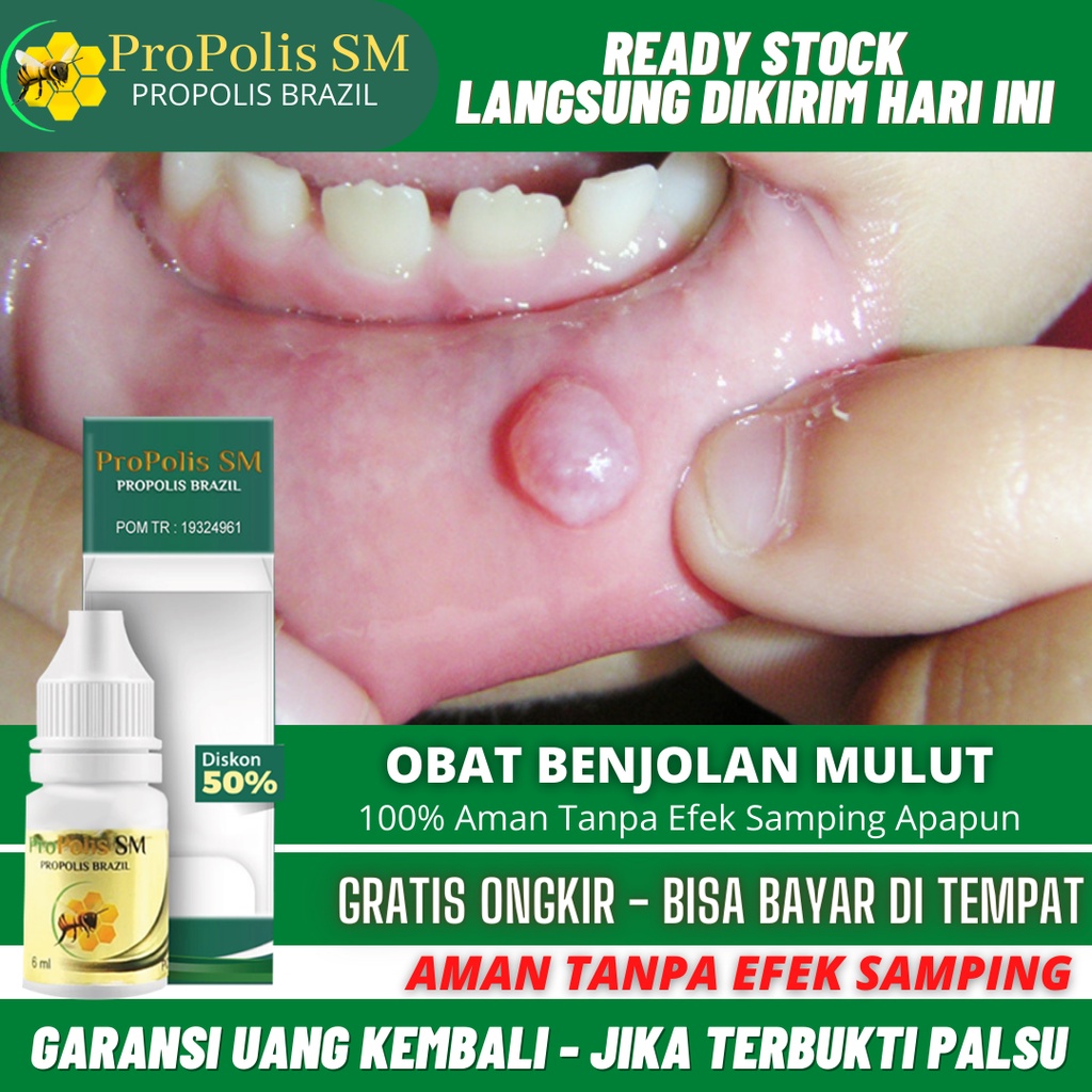Obat Penghilang Benjolan di Lidah / Mulut / Bibir, Obat Benjolan Di Pangkal Lidah, Obat Benjolan Di 
