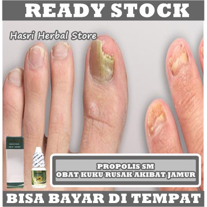 Obat Psoriasis Kuku, Obat Jamur Kuku, Obat Kuku Rusak Parah, Obat Kuku Busuk, Obat Kuku Kuning, Obat Kuku Berjamur, Obat Infeksi Kuku Jempol, Obat Kuku Cantengan, Obat Perawatan Kesehatan Jamur Pada Kuku Dengan Propolis SM