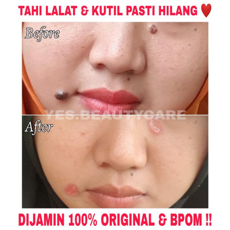 SWISS PARIS LOTION PENGHILANG TAHI LALAT &amp; KUTIL - SPESIALIS_TAILALAT - KRIM TAI LALAT OBAT ORIGINAL