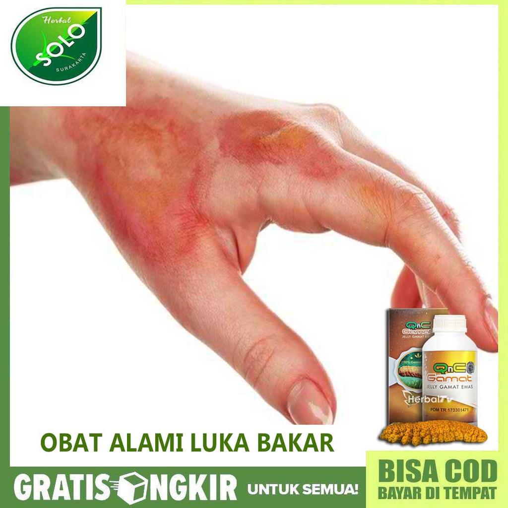 Obat Luka Bakar Kulit Kemerahan Lecet Kulit Melepuh Rasa Sakit Di Area Luka Qnc Jelly Gamat Asli Shopee Indonesia