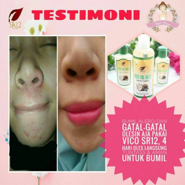 Testimoni Vico Oil Mengatasi Jerawat Komedo Dan Masalah Wajah Lainnya Indonesia