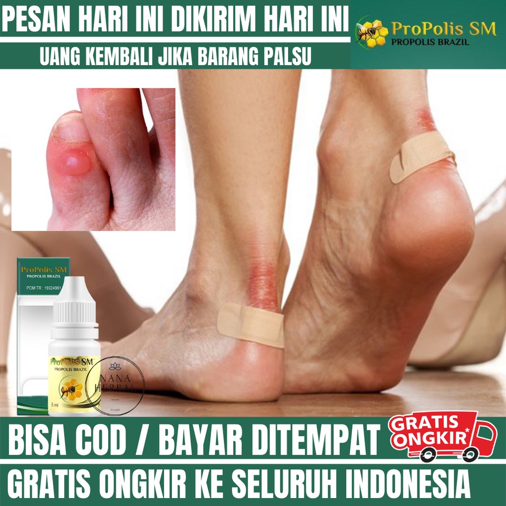 Obat Kulit Lecet, Kulit Gatal Iritasi, Iritasi Kulit Wajah, Tangan, Kaki / Tumit, Obat Iritasi Kulit