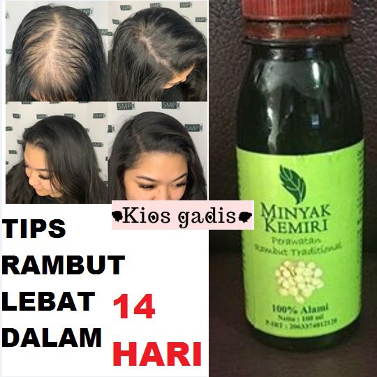 Jual Minyak Kemiri Rambut Rontok Uban Botak Penyubur Ketombe Gatal Kering Dan Rambut Merah Indonesia Shopee Indonesia