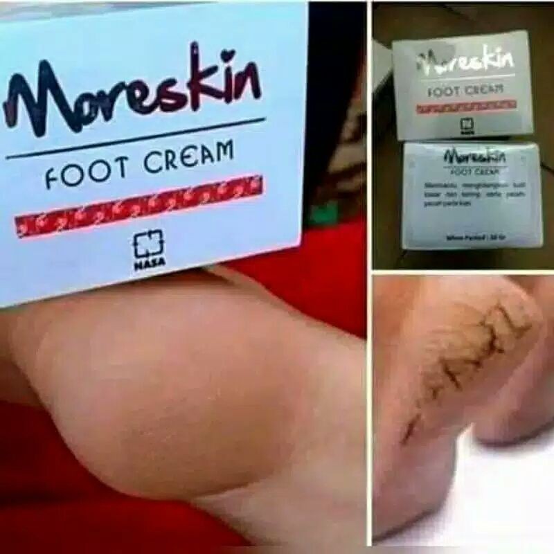 OBAT KAKI PECAH DAN KERING - MORESKIN FOOT CREAM - CREAM KAKI PECAH - CREAM KAKI KAPALAN KAKI KASAR