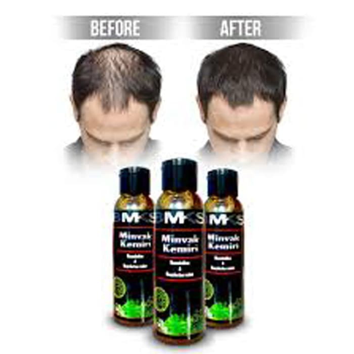 Jual Minyak Penumbuh Dan Penyubur Rambut Ampuh Minyak Pelebat Rambut Indonesia Shopee Indonesia