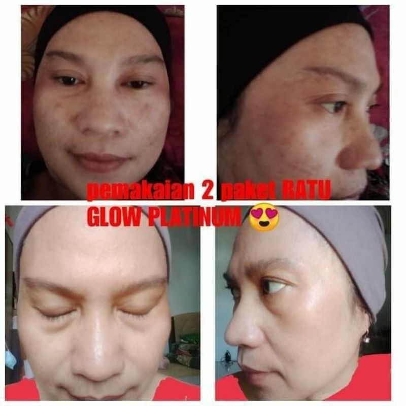 Ratu Glow Skincare Original BPOM paket acne brightening jerawat flek kusam Lo