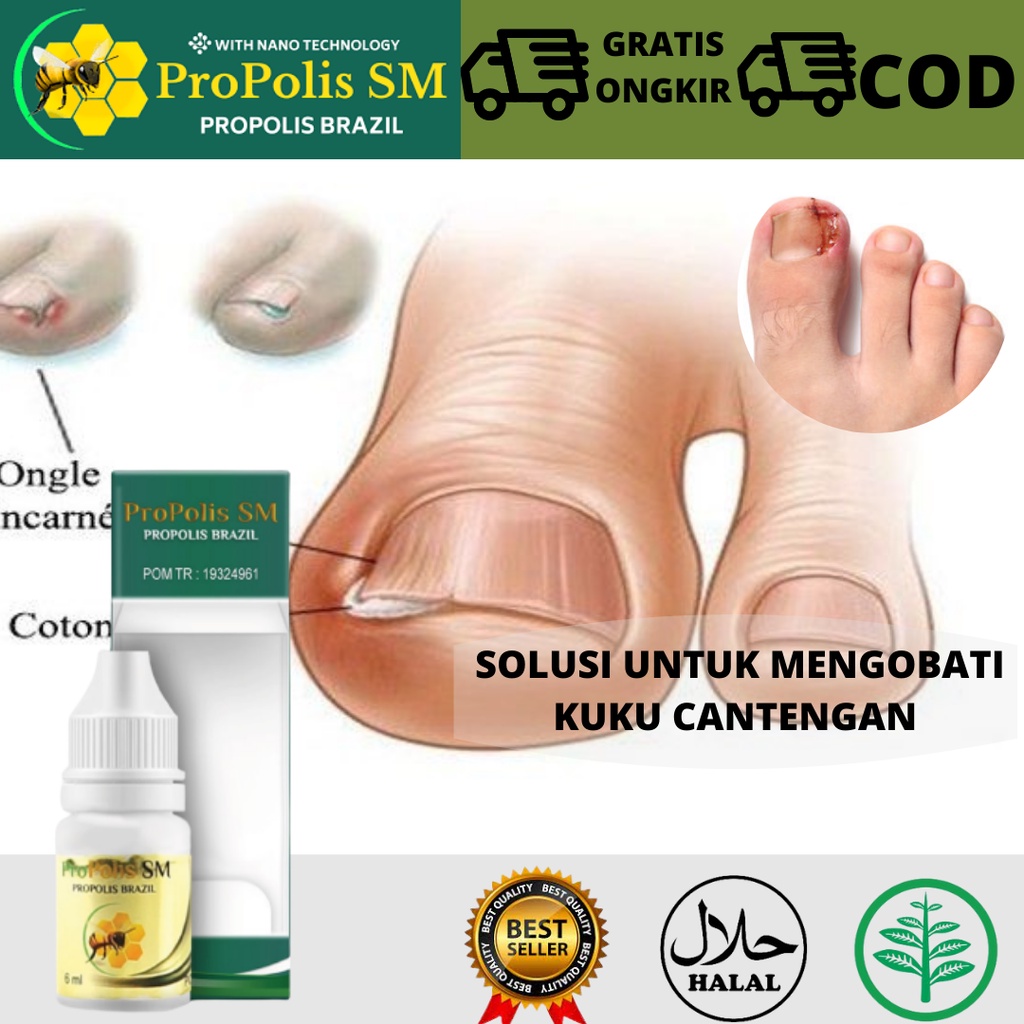 Jual Obat Cantengan Di Jempol Kaki Obat Kuku Cantengan Solusi Kaki