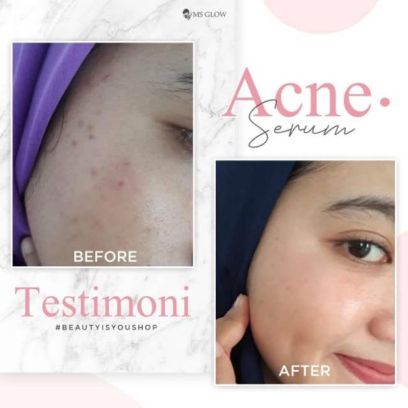 Serum Acne MS Glow 100% original skincare prawatan wajah wanita termurah (bisa cod)