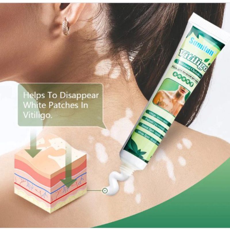 OBAT VITILIGO & LEUKOPLAKIA & SALEP VITILIGO & SALEP LEUKOPLAKIA
