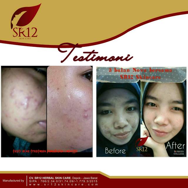 Acne Treatment Cream SR12 Penghilang Noda Bekas Jerawat Luka Stretch Mark