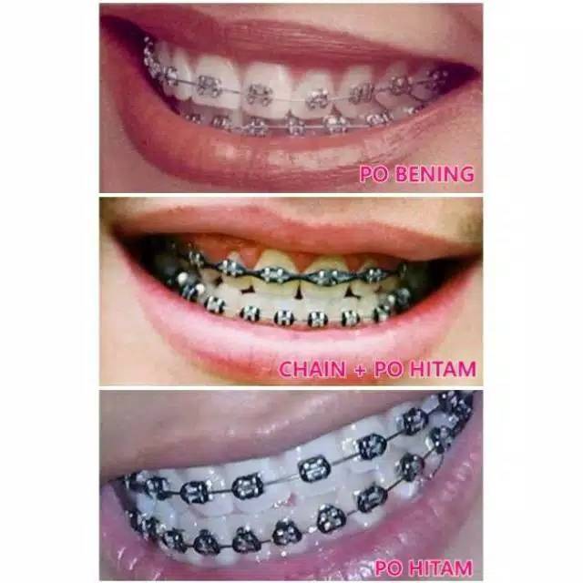 Warna Braces Yang Sesuai Untuk Kulit Gelap | Ide Perpaduan Warna