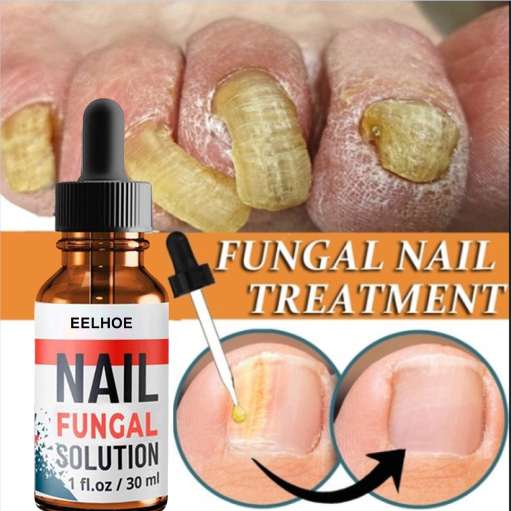 EELHOE Nail Repair Serum Fungal Nail Perawatan Esensi Serum Jamur Kuku Essence Oil Serum Nail Treatm