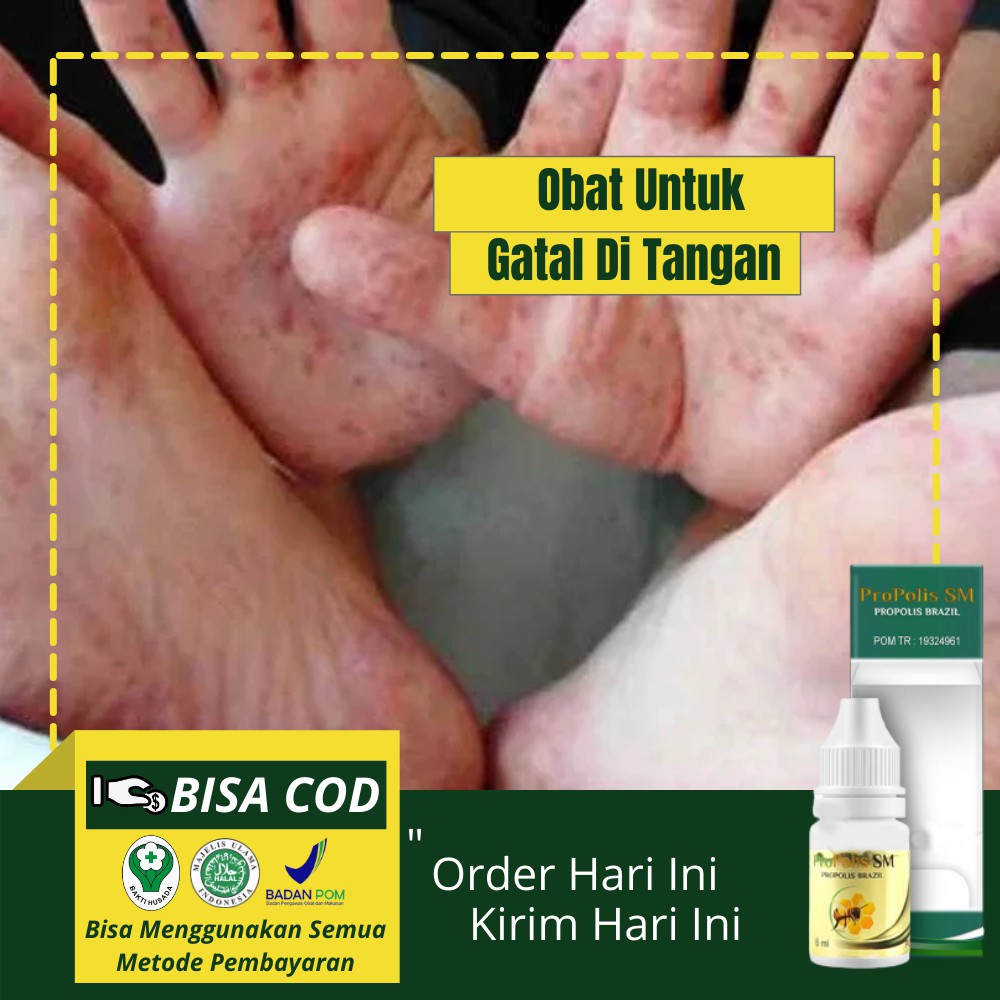 Obat Gatal Pada Jari Tangan Obat Alami Gatal Di Tangan Bintik Berair Dengan Propolis Sm Shopee Indonesia