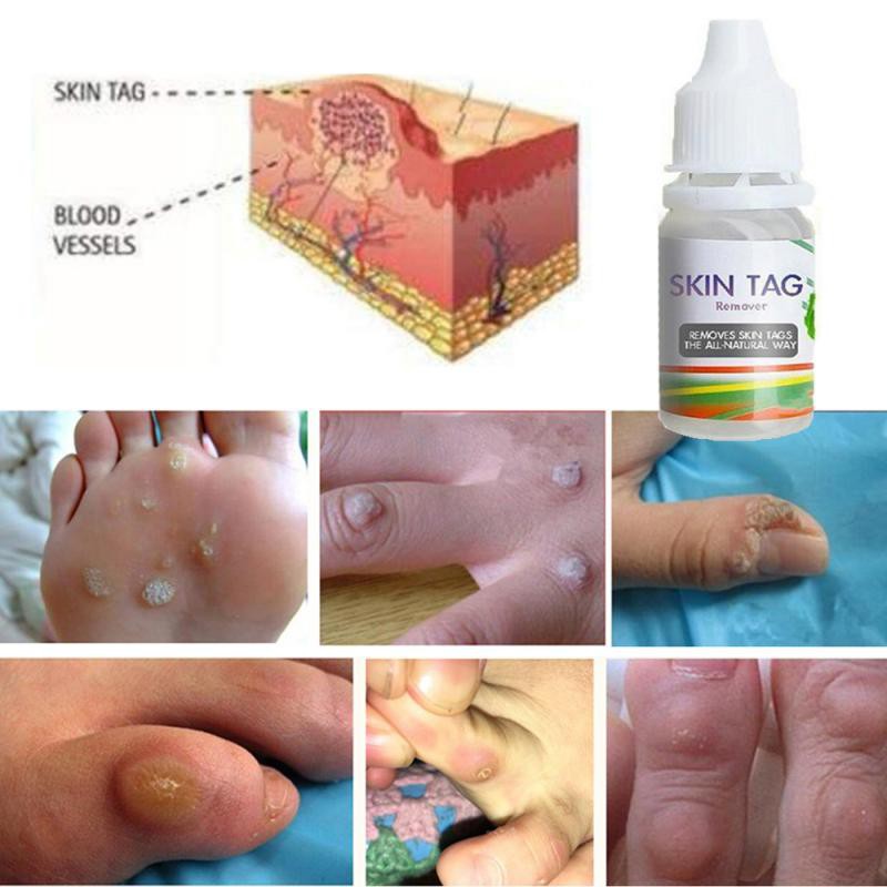 [100% Efektif] Obat Penghilang Tahi Lalat Obat Kutil Obat Kutil Kelamin Skin Taq Remover 10 ml