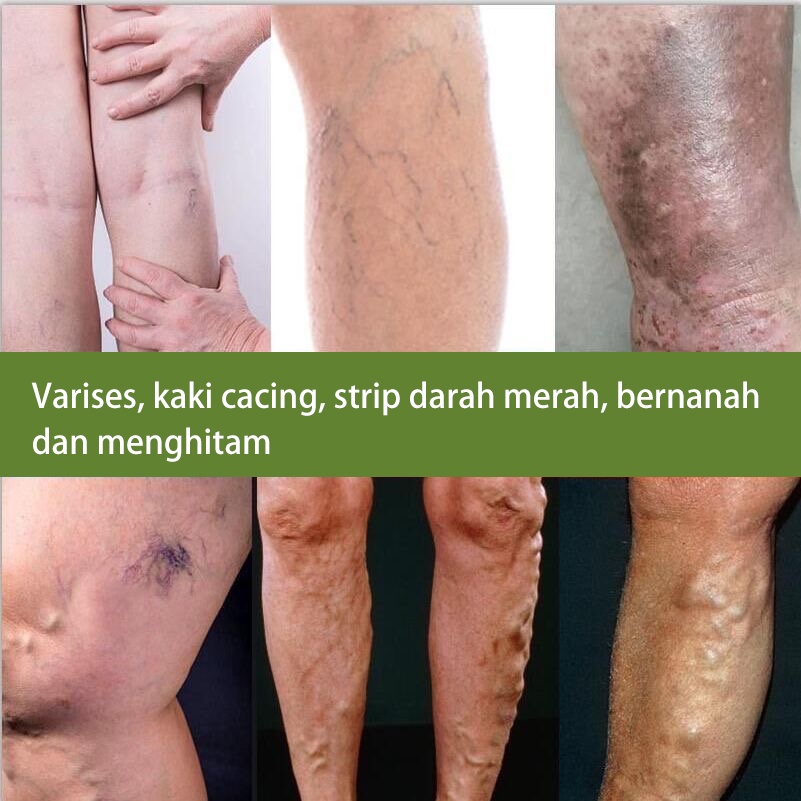 obat varises 50g Varises Obat Varises Paling Ampuh Pijat kaki untuk menghilangkan rasa sakit / mengeruk meridian / perawatan relaksasi vena dan krim perbaikan Bengkak Benjolan Vaskulitis Flebitis Pengobatan Vaskulitis