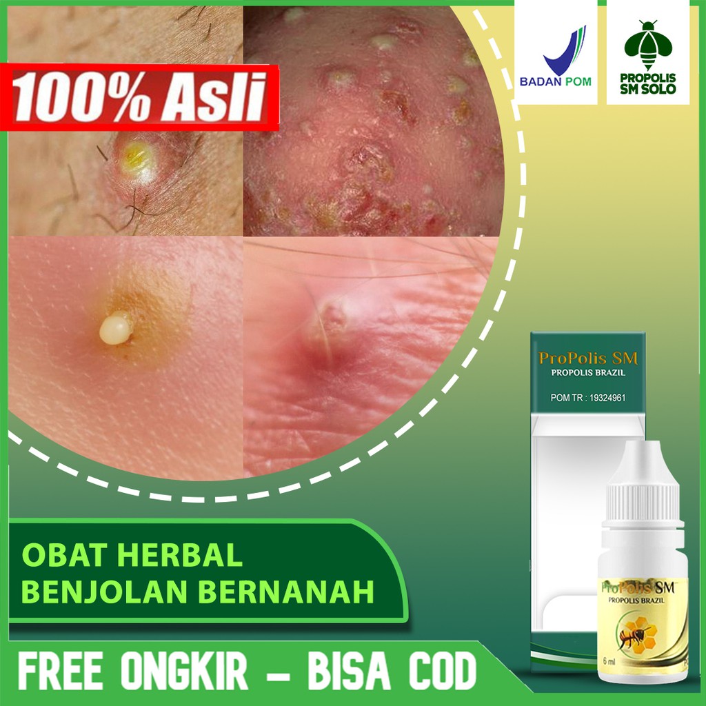 Obat Benjolan Bernanah Di Kepala, Jerawat Kulit Kepala, Tetes Benjolan Di Kepala, Propolis SM Brazil