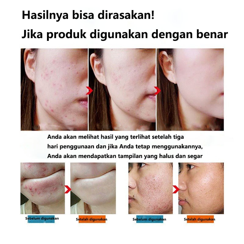 acnecare Krim Wajah Berjerawat obatjerawat 50g herbal ekstrak krim jerawat  halal  menghilangkan bekas jerawat  bekas jerawat  memutihkan kulit