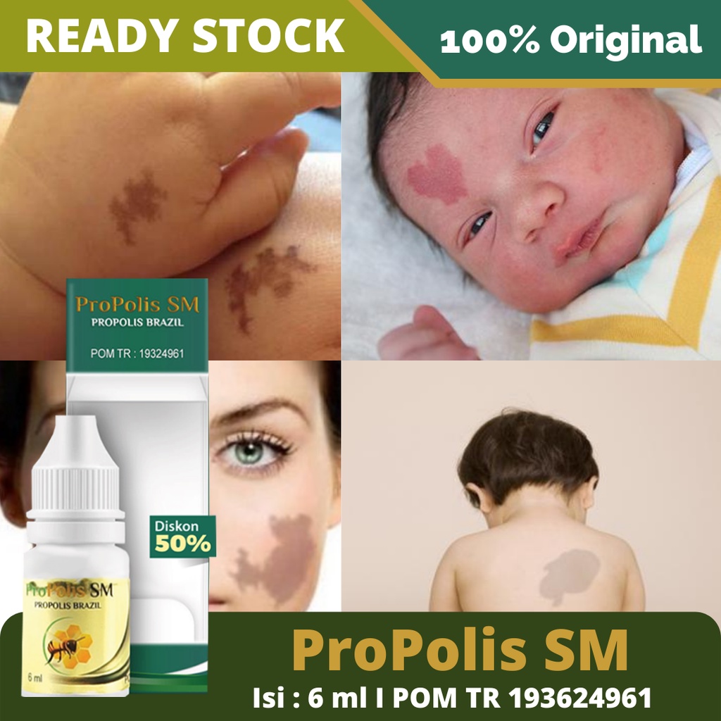 Obat Hemangioma, Penghilang Hemangioma, Penghilang Tanda Lahir Merah Aman Untuk Bayi - Propolis SM