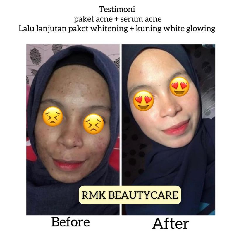 paket acne whitening cream jerawat radang jerawat bruntusan RMK