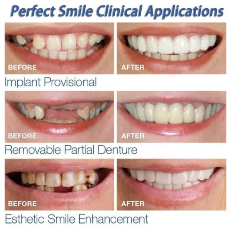 Snap On Smile ORIGINAL 100% Gigi Palsu berkualitas