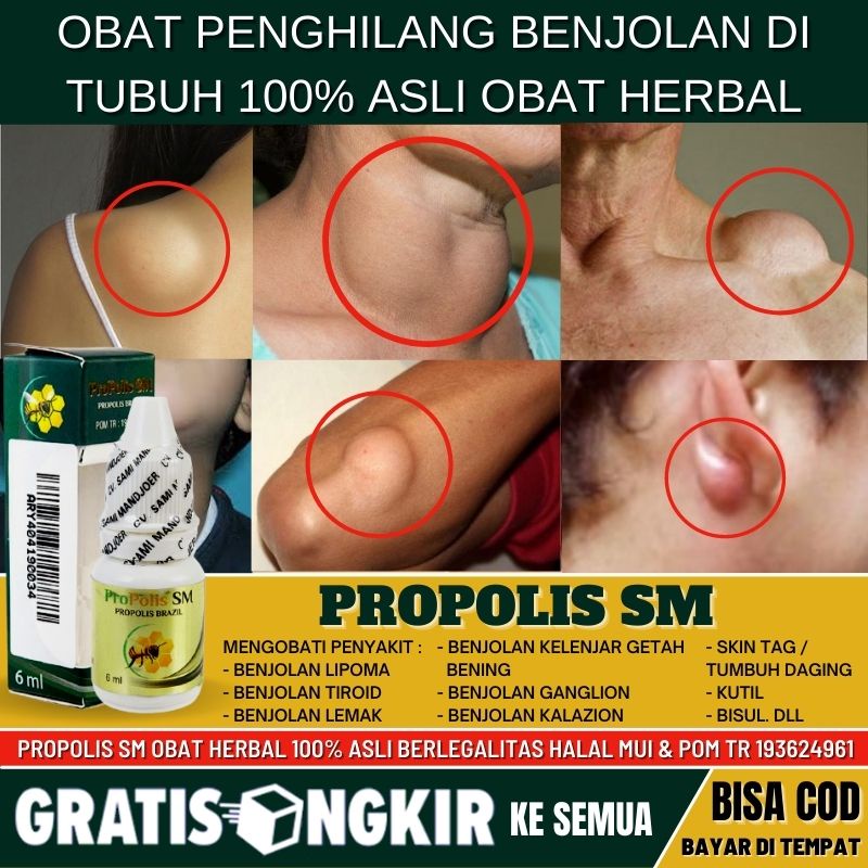 Obat Benjolan di Selangkangan Alami - Penghilang Benjolan di Area Kelamin -  Obat Benjolan Untuk Pri
