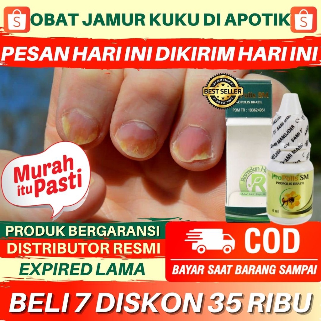[Original] Obat Kuku Berjamur Di Apotik, Kuku Rusak Busuk Berjamur Infeksi kuku Jempol Obat Cantenga