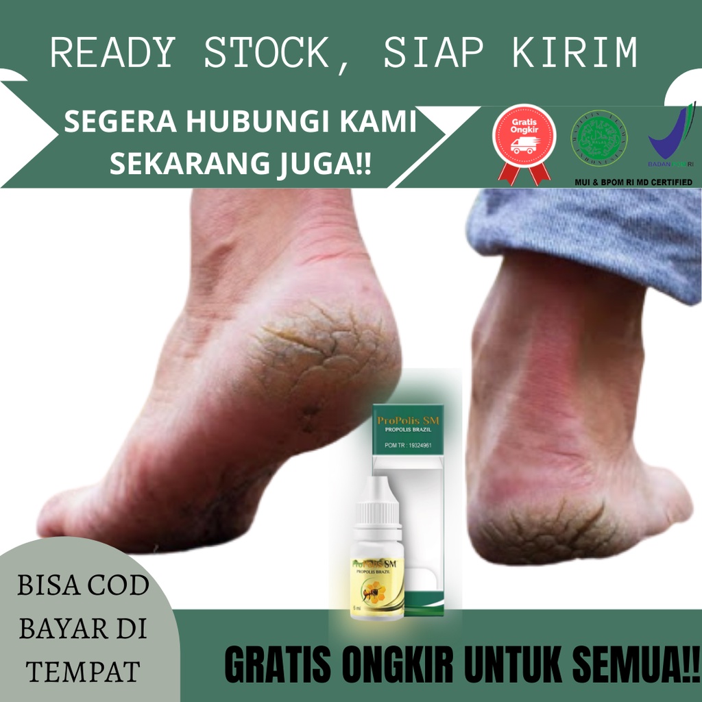 Obat Kaki Pecah dan Kering, Obat Kaki Rayapan, Obat Rayapan di Kaki, Obat Kaki Rayapan dan Bau, Obat