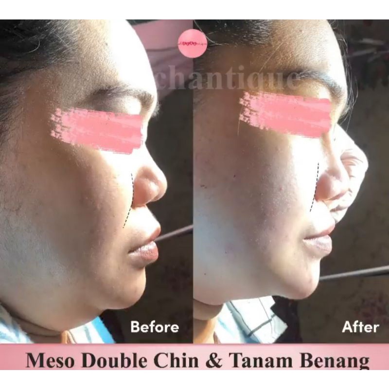Meso Double Chin