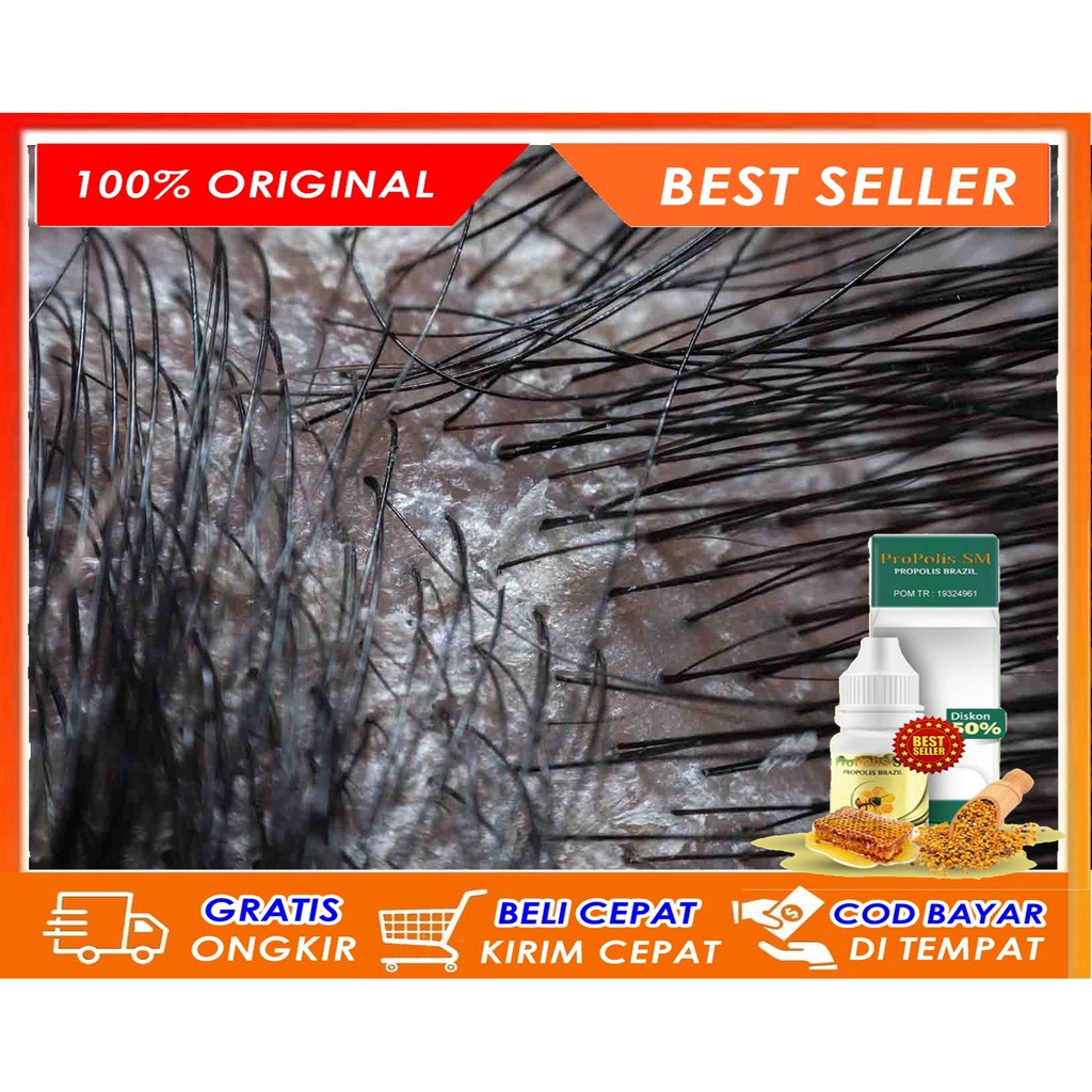 Obat Ketombe Berkerak, Penghilang Ketombe Rambut Mengerak, Gatal, Ketombe Tebal & Borok Propolis SM