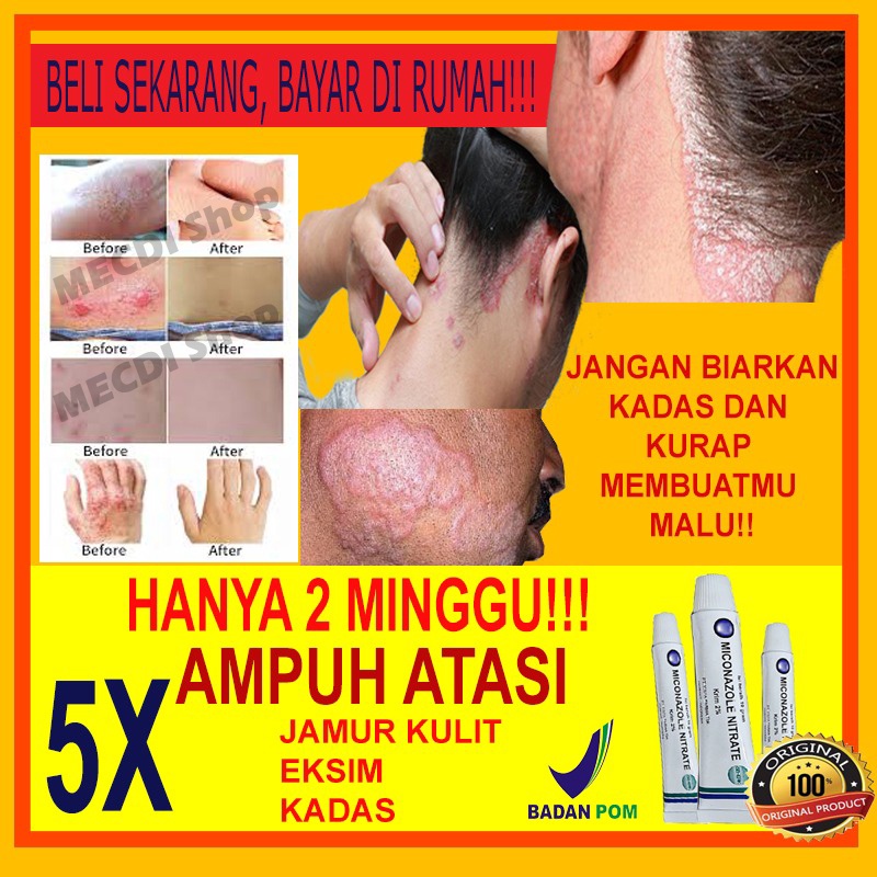 Salep Gatal - Salep Penghilang Jamur Kulit - Salep Kulit Original - Obat Kulit - Obat Penghilang Kad