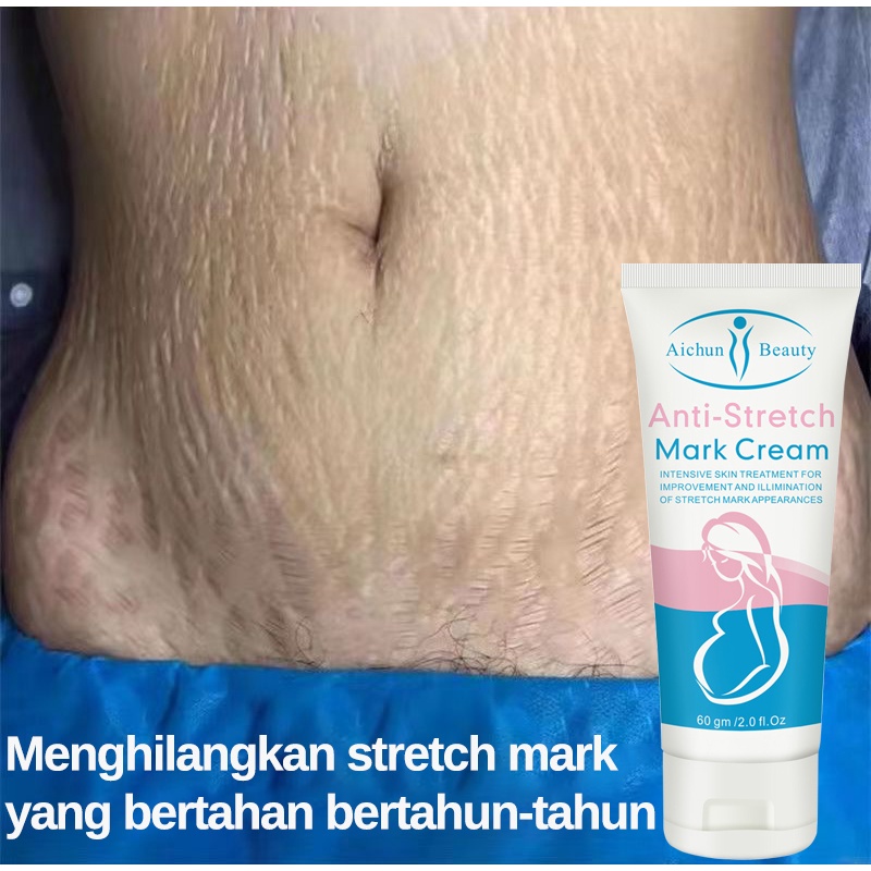 Salep penghilang bekas luka Menghilangkan stretch mark Cream Krim 60g Perut Gatal dan Anti Stretchma